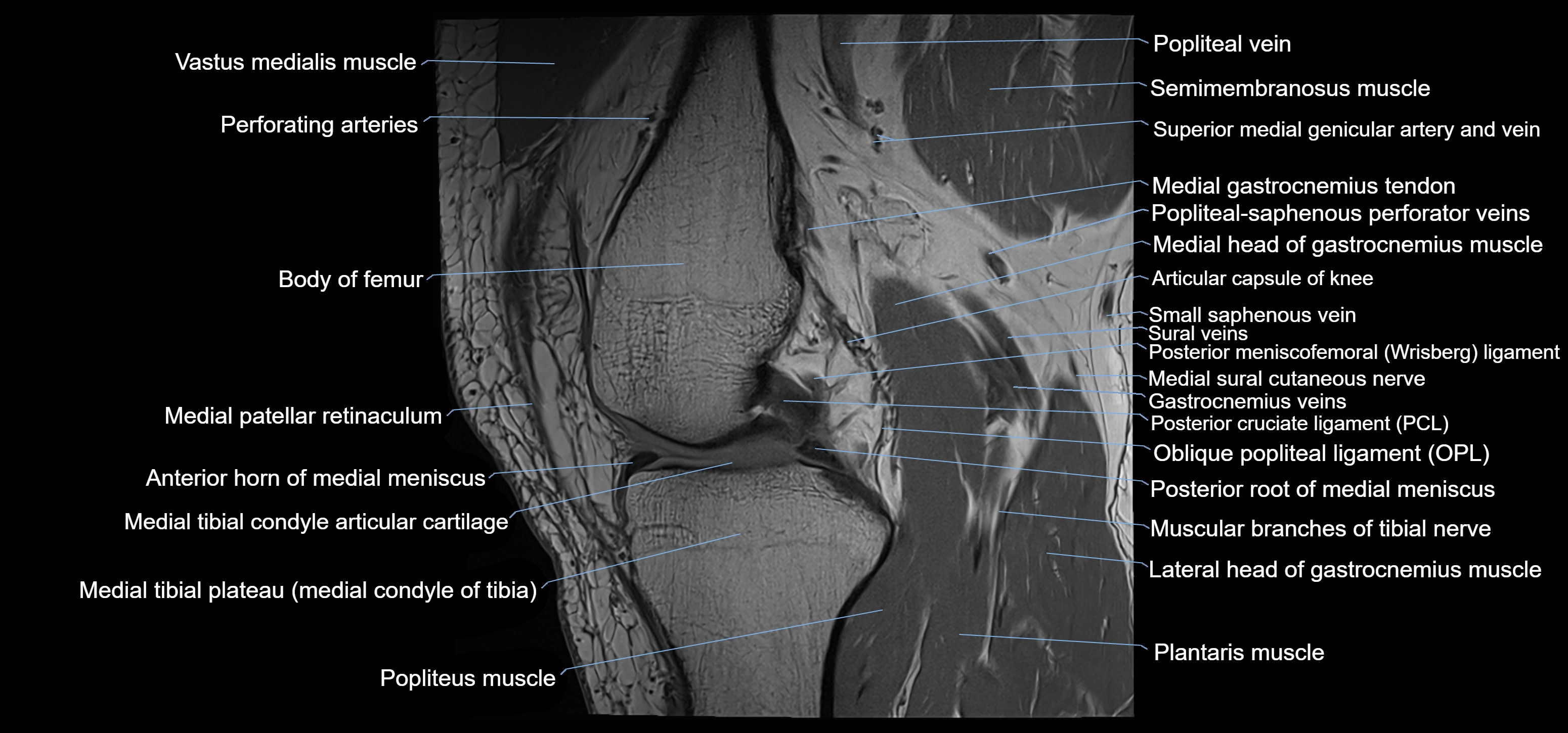 MRI knee sagittal cross sectional anatomy labelled 3T radiology image-00021.webp
